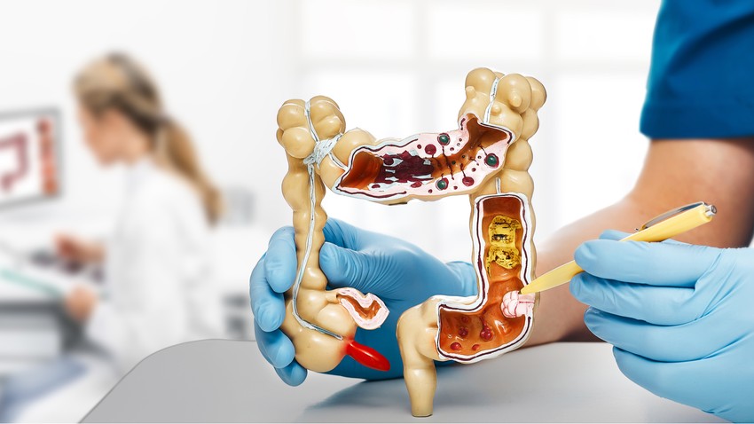 Hogyan zajlik a vastagbélszűrés?A szűrés segítségével a vastagbéldaganat kialakulására utaló jelek időben felfedezhetők, ezzel a betegség megelőzhető vagy jó eséllyel gyógyítható.