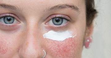 Rosacea és UV sugárzás: hogyan védekezzünk?