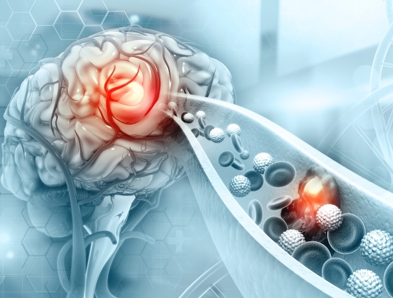 migrén, tünetei, oka, fejfájás, tenziós fejfájás prolaktin, CGRP
