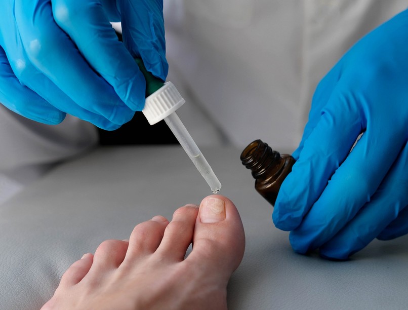 körömgomba kezelés otthon