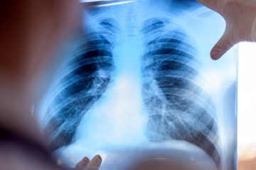 Milyen betegségek okozhatnak árnyékot a tüdőröntgenen? A szakorvos elmagyarázza