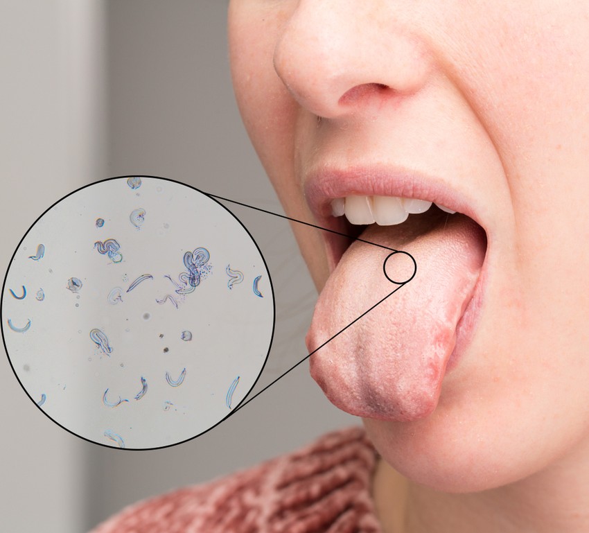 Felnőtteknél a lepedékes nyelv is utalhat a Candida által okozott gombás fertőzésre. A gomba a normál szájüregi flóra természetes része, ám az immunrendszer legyengülése esetén elszaporodhatnak a szájüregben.