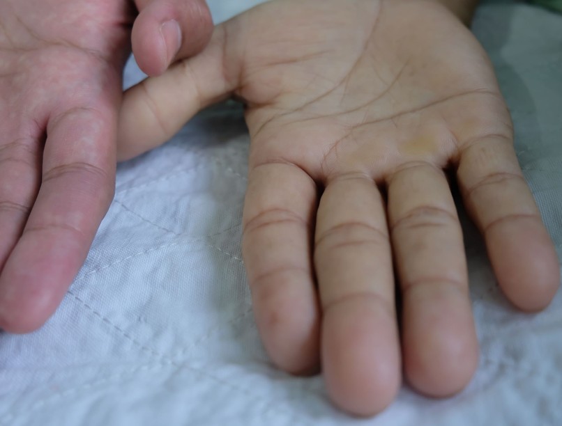 Megaloblasztos anémia tünet vizsgálat kezelés