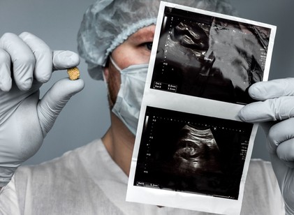 Mitől alakul ki a vesekő? Ez az, amit a háttérben zajló folyamatokról tudnia érdemes című cikk nyitóképe