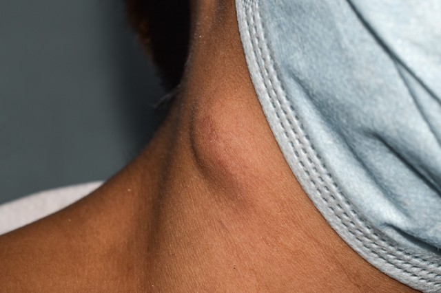 Csomók, dudorok a bőr alatt - így lehet felismerni a nyirokrákot