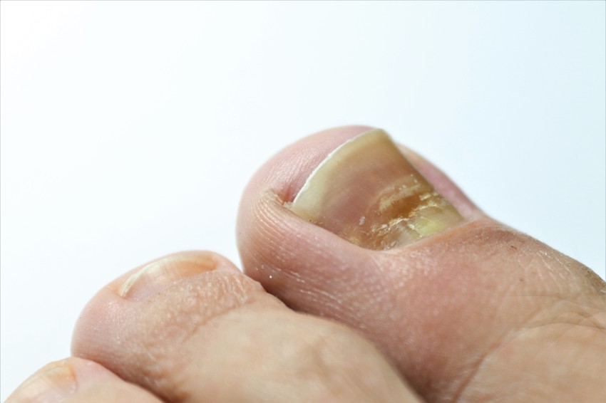 Az eredeti köröm színe, állapota, formája, és bizonyos etéren tapasztalt eltérések felismerése akár az életünket is megmentheti.