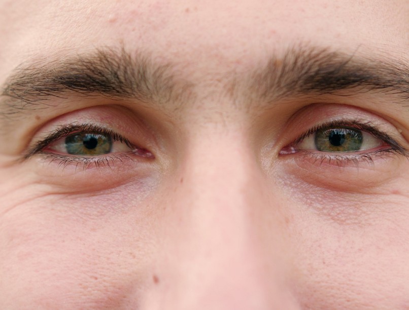 szénanátha allergia szem kötőhártya gyulladás tünet