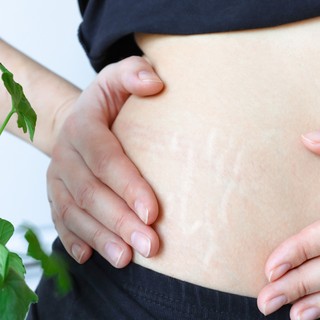 Csíkok a bőrön: striának tűnhet, pedig hormonális oka is lehet! című cikk nyitóképe
