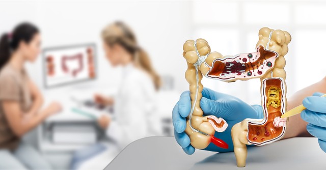 Őssejtekkel segítik a Crohn-betegek gyógyulását a Semmelweis Egyetemen