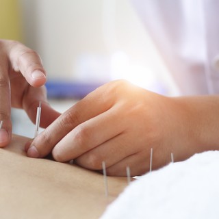 Mire jó az akupunktúra? című cikk nyitóképe