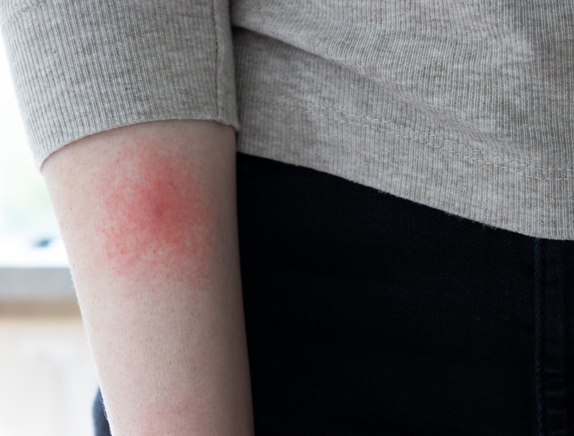 lyme-kór korai tünetei