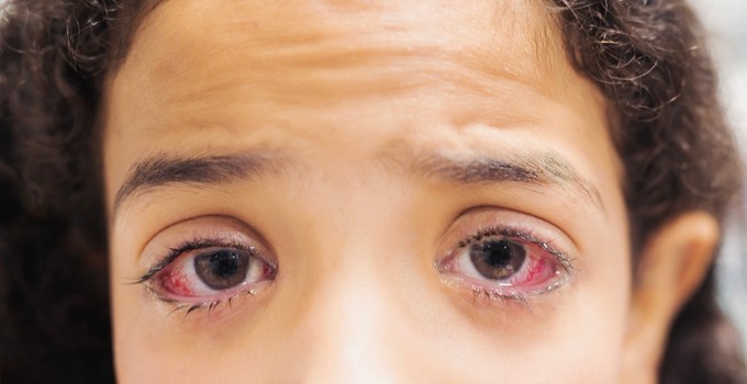 Nem múló kötőhártya gyulladás: mi számít annak, és mit lehet ilyenkor tenni? című cikk nyitóképe