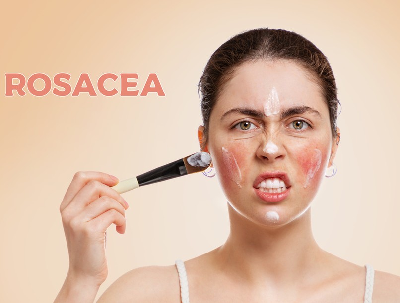 rosacea, bőrpír, bőrbetegség