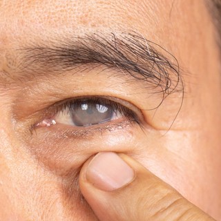 Szürkehályog műtét után: a gyógyulás hetei, amiről kevesen beszélnek című cikk nyitóképe