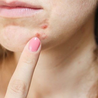 Hormonzavar is okozhatja, ha így néz ki az arcbőre című cikk nyitóképe