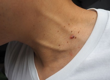 Az ilyen szemölcsszerű bőrkinövések a nyakon előrejelezheti a cukorbetegség egyik típusát a tudósok szerint! című cikk nyitóképe