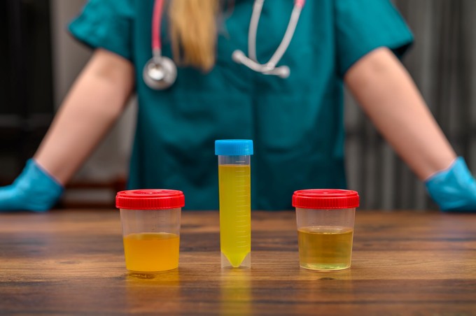 Nem csak a színe számít: 3 vészjósló jel a vizeletben, amit soha ne hagyjon figyelmen kívül! című cikk nyitóképe