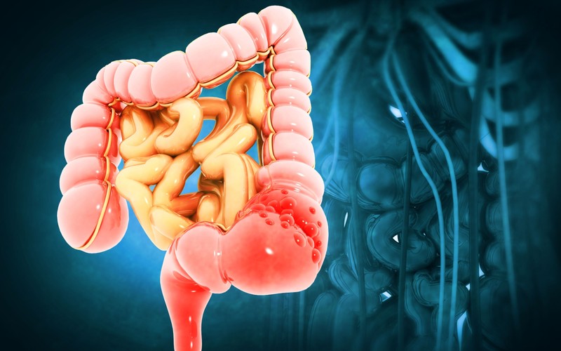 Vastagbélrák esetén milyen kemoterápiás kezeléseket alkalmazhatnak?