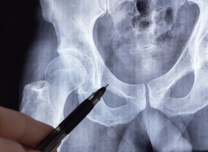 Mit tehetünk idősebb korban, hogy ne törjenek olyan könnyen a csontok? című cikk nyitóképe