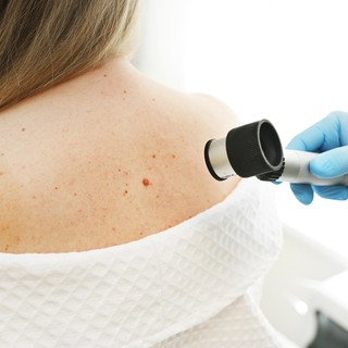 Melanómát diagnosztizáltak? Ezeket a kérdezze meg az orvosától című cikk nyitóképe