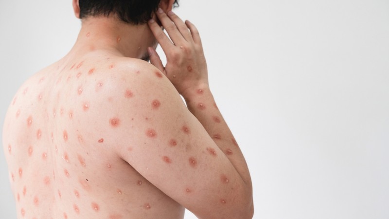 Elharapózott a gyűlöletbeszéd a Twitteren a majomhimlő terjedése miatt