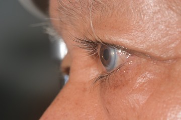 Örökletesen magas koleszterinszint: ez az elváltozás jelzi a szem szaruhártyáján