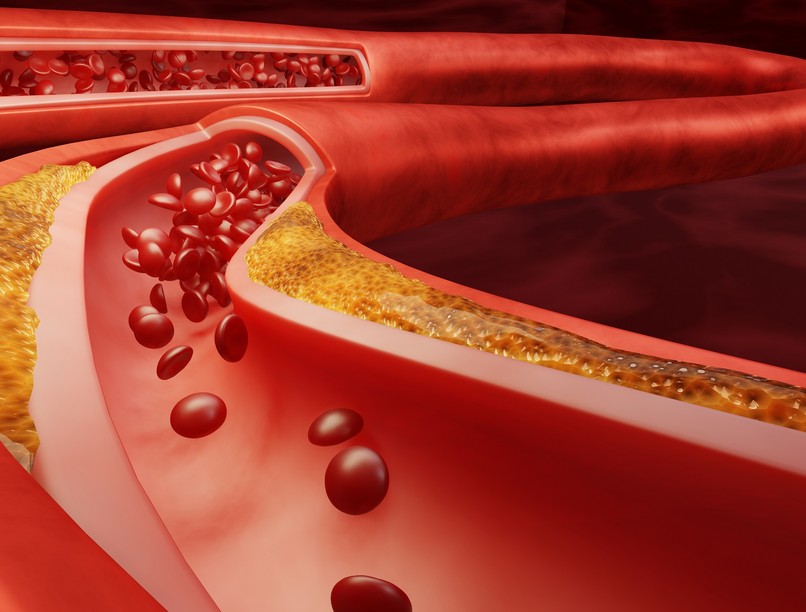 stroke agyvérzés tünet jel mentők