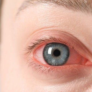 Kötőhártya-gyulladás esetén így nyerheti vissza leggyorsabban a szemei egészségét című cikk nyitóképe