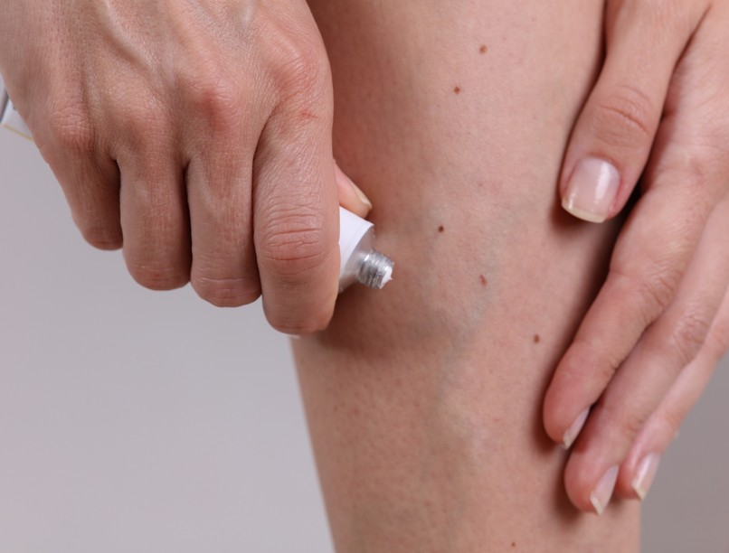 visszérkrém segít probléma panasz heparin