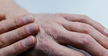  Telente száraz, cserepes a keze? Ezt tanácsolja a bőrgyógyász 