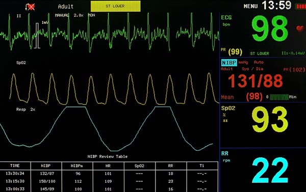 Ne adjon esélyt a stroke-nak, vizsgáltassa meg szívét!