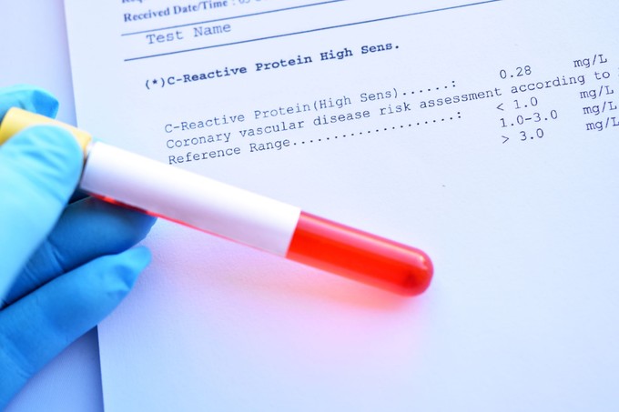 Mit árul el a CRP-érték az egészségi állapotunkról? Ezt üzeni a szervezete, ha a CRP-eredménye magas című cikk nyitóképe