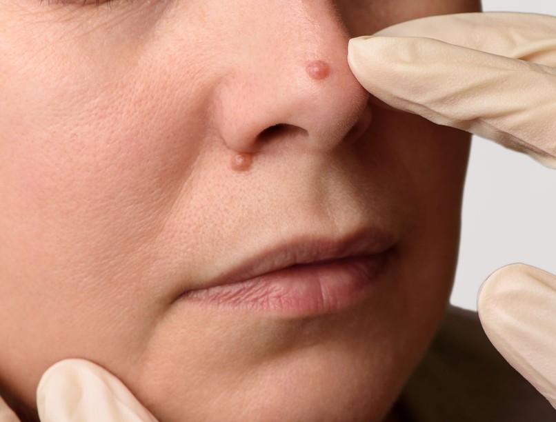 anyajegy eltávolítás nyoma szövettani vizsgálat