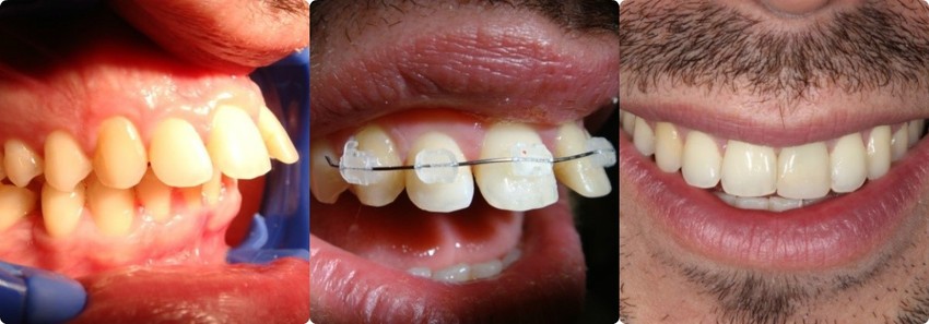 A fogszabályozás nem csak esztétikai kérdés! (X)