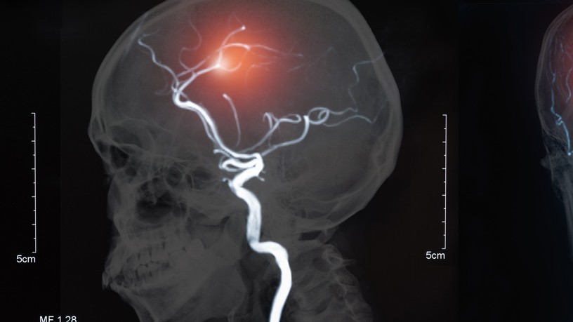 stroke, rehabilitáció, agyi infarktus, beszédzavar, halálozás