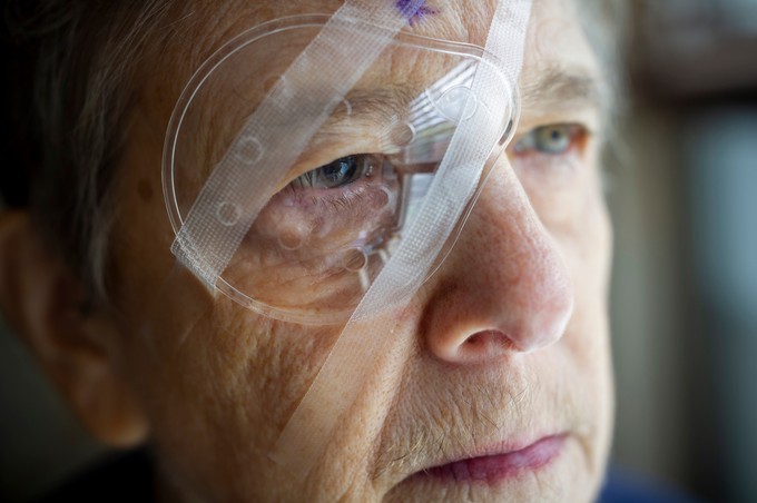 Mire vigyázzunk szürkehályog-műtét után? Ezeket tartsa be a gyógyulás érdekében című cikk nyitóképe