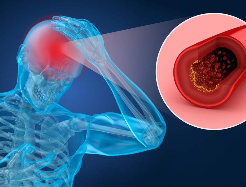 Stroke TIA különbség vérrög tünet