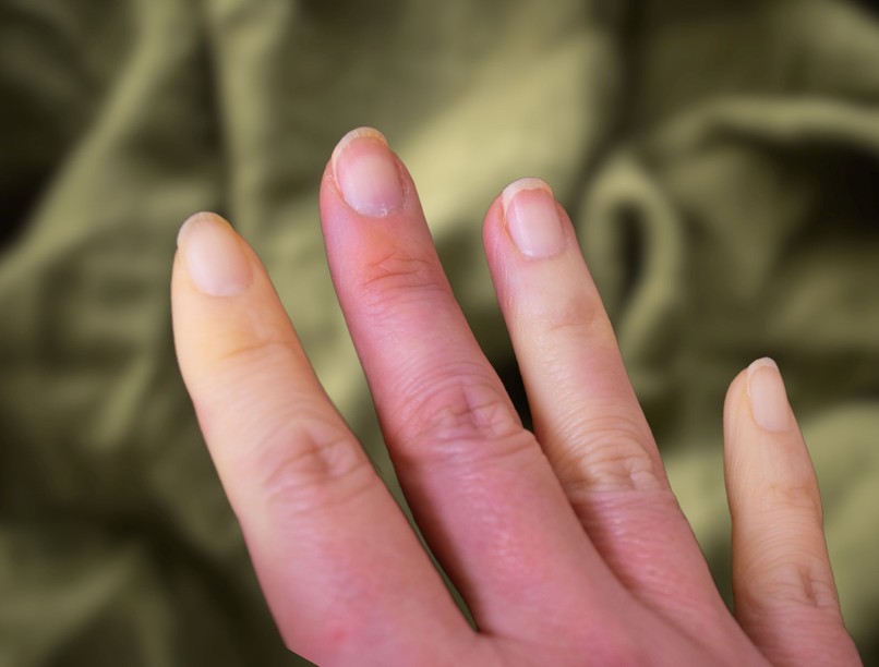 Raynaud-szindróma hideg idő