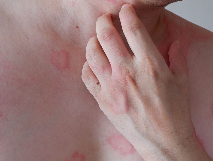 anafilaxia tünetek, jelek, két hullám, életveszélyes állapot