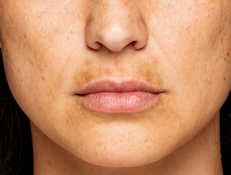 pigmentfolt ellen bőr arc