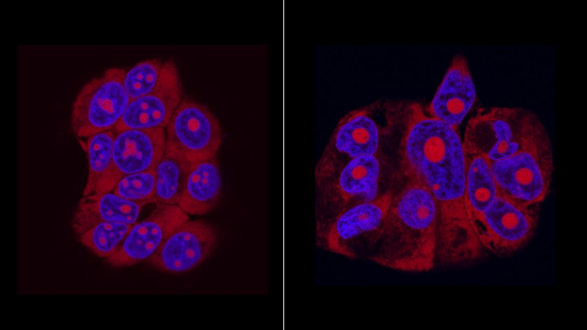 Emlőráksejtek kiindulási és „zombi” állapotban. Bal oldalon a kiindulási sejtek láthatók több sejtmagvacskával (élénk pirossal jelölve a kék sejtmagokon belül). Jobb oldalon a kemoterápiát túlélő TIS sejtek, ahol ezek egyetlen nagy magvacskává állnak össze. Ez segíti a sejtek TIS-re jellemző fokozott fehérje- és citokin-termelését. Felvétel: Bajtai Eszter
