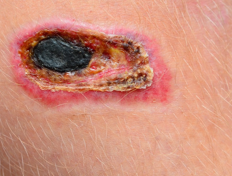 szöveti nekrózis tünet vizsgálat kezelés