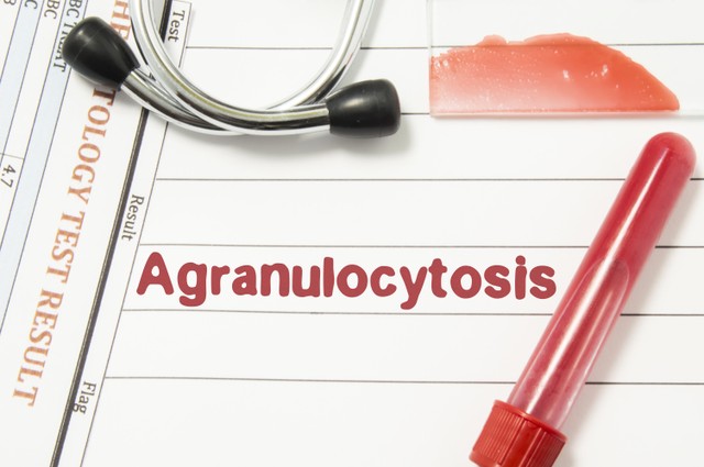 Agranulocitózis tünetei, vizsgálata és kezelése