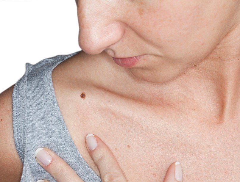 melanóma bőrrák világnap tünet rút kiskacsa ABCDE