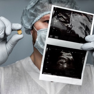 Mitől alakul ki a vesekő? Ez az, amit a háttérben zajló folyamatokról tudnia érdemes című cikk nyitóképe