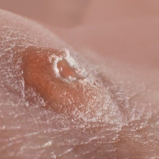A bél baktériumflórája is segíthet a HPV legyőzésében - ezeket tartsa be! című cikk nyitóképe