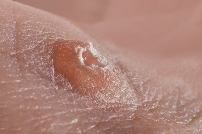 A bél baktériumflórája is segíthet a HPV legyőzésében - ezeket tartsa be! című cikk nyitóképe