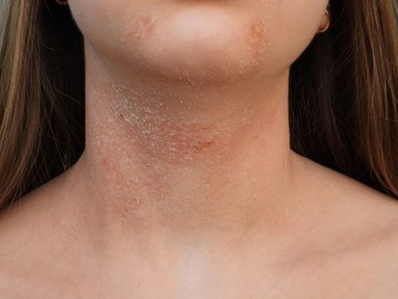 Mi okozza az atópiás dermatitiszt és hogyan kezelhető? Erről jó, ha tud!