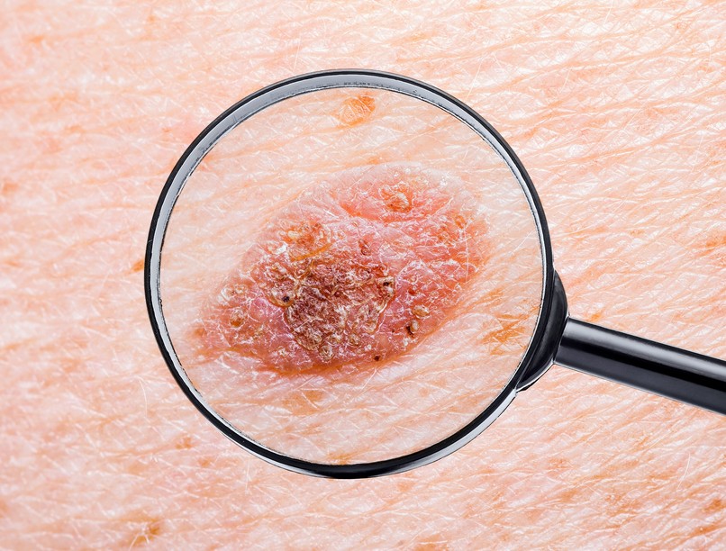 hámló gyanús folt bőr bőrrák tünet