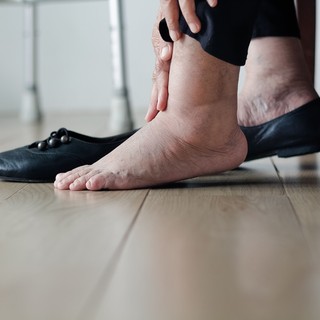 Mitől dagadhat a boka, vizesedhet a láb? A kardiológus elmondja című cikk nyitóképe